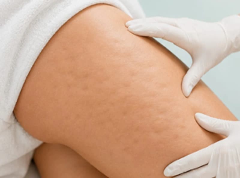 Cellulite huidprobleem